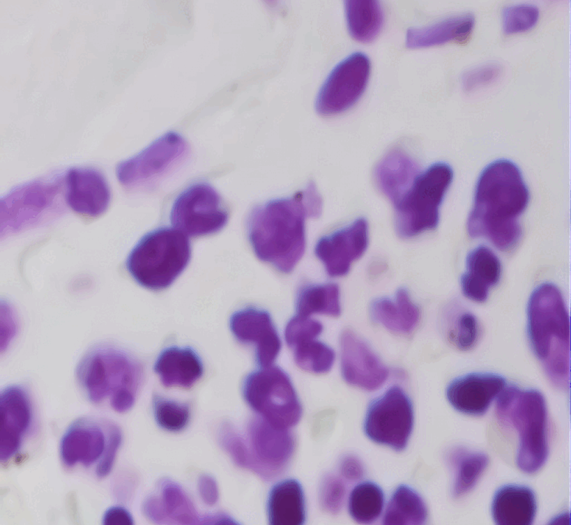 Anemia